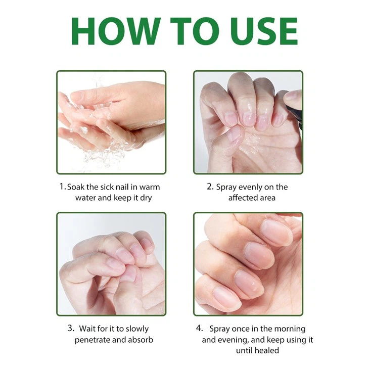 MOOYAM 7 Days Nail Fungus Treatment – Ginger Infused Nail Spray For Fast Relief